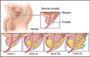 Prostat kanseri